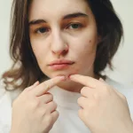 Why Teenagers Get So Much Acne: Understanding the Causes of Adolescent Breakouts
