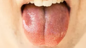 The Vital Role of Saliva: Key to Oral Health and Digestive Success