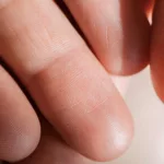 Why Some People Have No Fingerprints: Understanding the Rare Phenomenon of Adermatoglyphia
