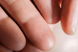 Why Some People Have No Fingerprints: Understanding the Rare Phenomenon of Adermatoglyphia