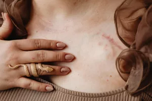 Bruises Explained: Causes, Healing, and How to Prevent Them