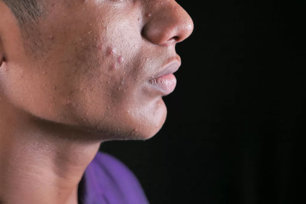 Understanding Acne: Causes, Treatments, and Why Pimples Occur