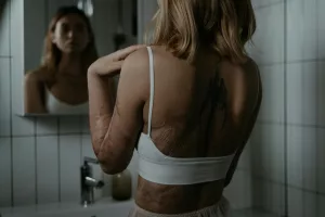 Why Do We Get Scars? Examining the Process of Skin Healing and Scar Formation
