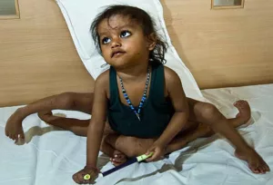 Supernumerary Limbs: When the Body Grows More Than Nature Intended