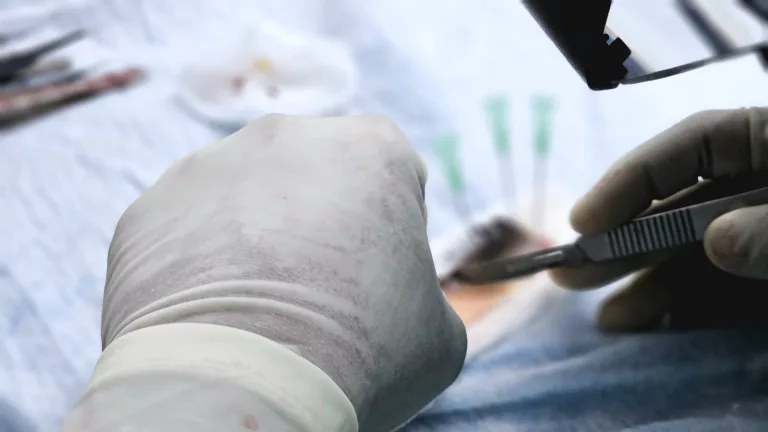 10 Reasons Why Your Hair Transplant Failed