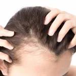 Hair Loss After Giving Birth: Exploring the Causes, Treatment Options, and Prevention Tips for Postpartum Alopecia