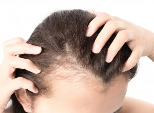 female hair loss