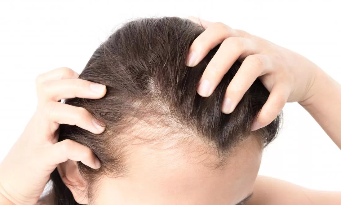 female hair loss