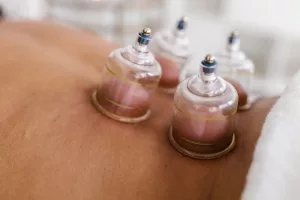 Cupping Therapy: Ancient Healing Techniques for Pain Relief, Relaxation, and Wellness
