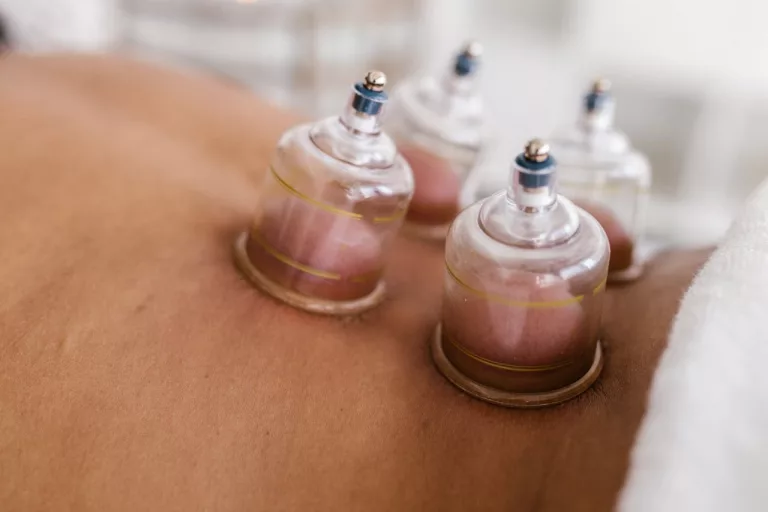 Cupping Therapy: Ancient Healing Techniques for Pain Relief, Relaxation, and Wellness
