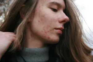 Why Do We Get Acne? Understanding the Causes and Factors Contributing to Acne Development