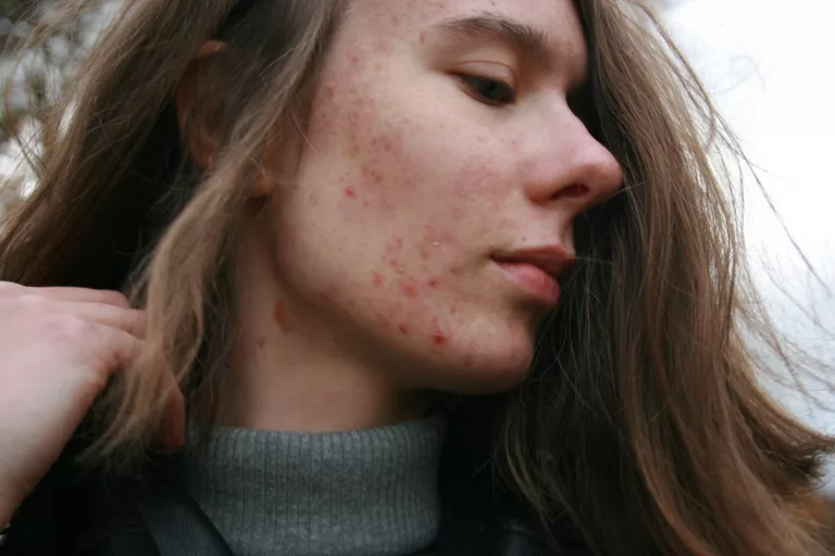 Why Do We Get Acne? Understanding the Causes and Factors Contributing to Acne Development