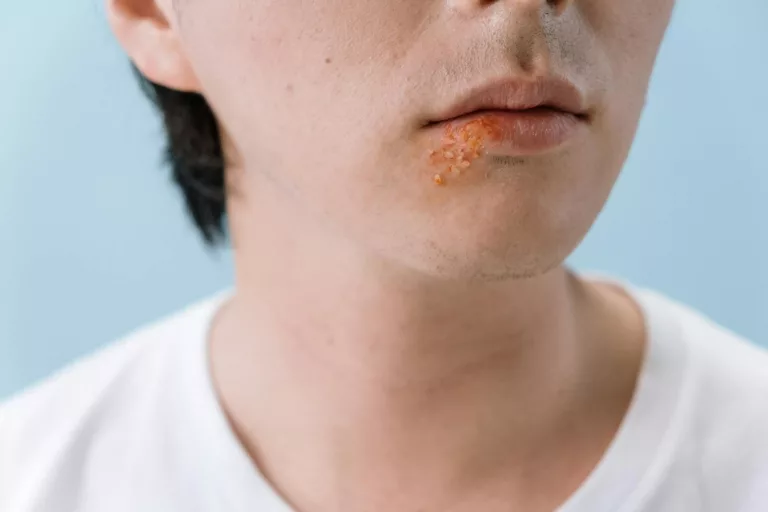 Herpes Management: Symptoms, Prevention & Treatment Tips