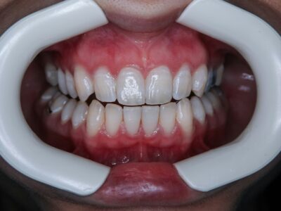 Wisdom Teeth: What Are They and Why Do They Get So Painful?